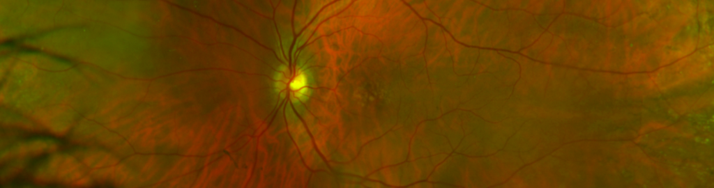 Retinal Health (part 1)